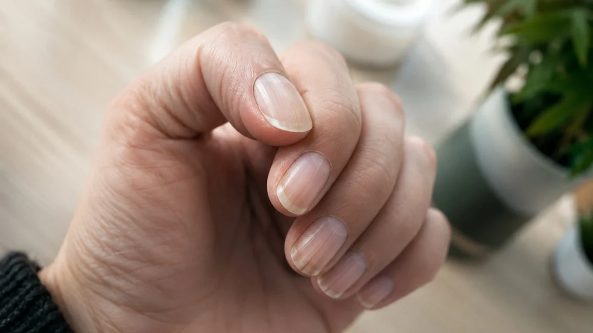 Dlaczego paznokcie pękają wzdłuż? Oto najczęstsze przyczyny